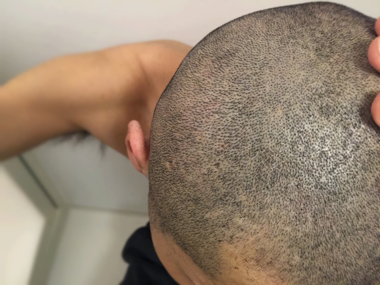 縮毛剛毛を簡単に坊主にフィリップスのバリカン[HC7460]でセルフ丸刈りも簡単！
