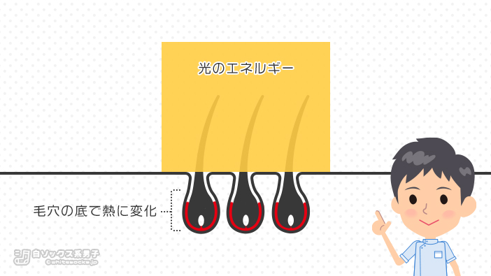 レーザーやIPL光による脱毛の図