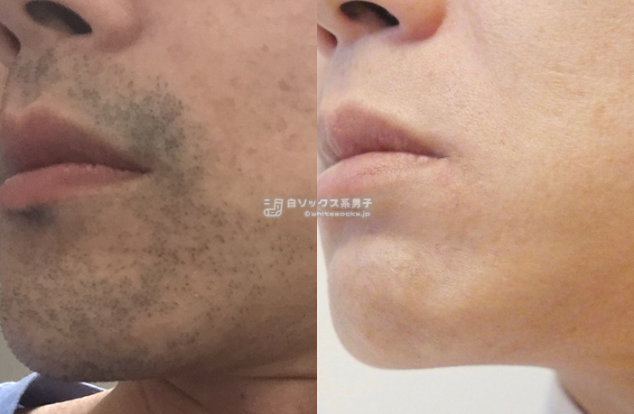 ヒゲ脱毛が上手い脱毛サロン:白ソックス系男子